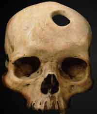 Trepanned skull